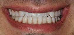 Before and After Invisalign in Bayside