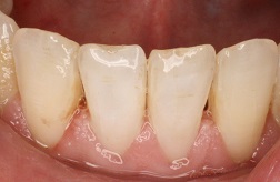 Bayside Before and After Teeth Whitening