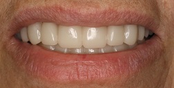 Before and After Dental Veneers in Bayside