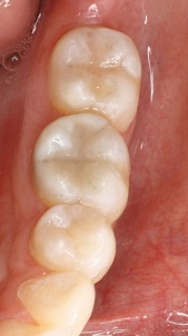 Before and After Dental Veneers in Bayside