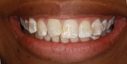 Before and After Dental Fillings in Bayside