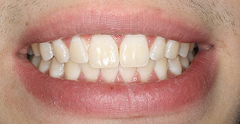 Before and After Teeth Whitening in Bayside
