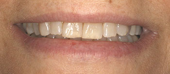 Before and After Teeth Whitening in Bayside