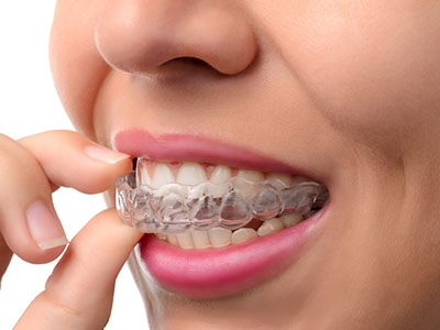 An adult woman is seen holding a clear dental retainer, with her mouth open as she examines it closely.